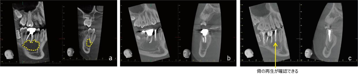 Case 02 Periodontal Cyst
