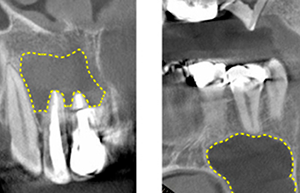 Figure 9: Root apex lesion with significant dissolution around the root